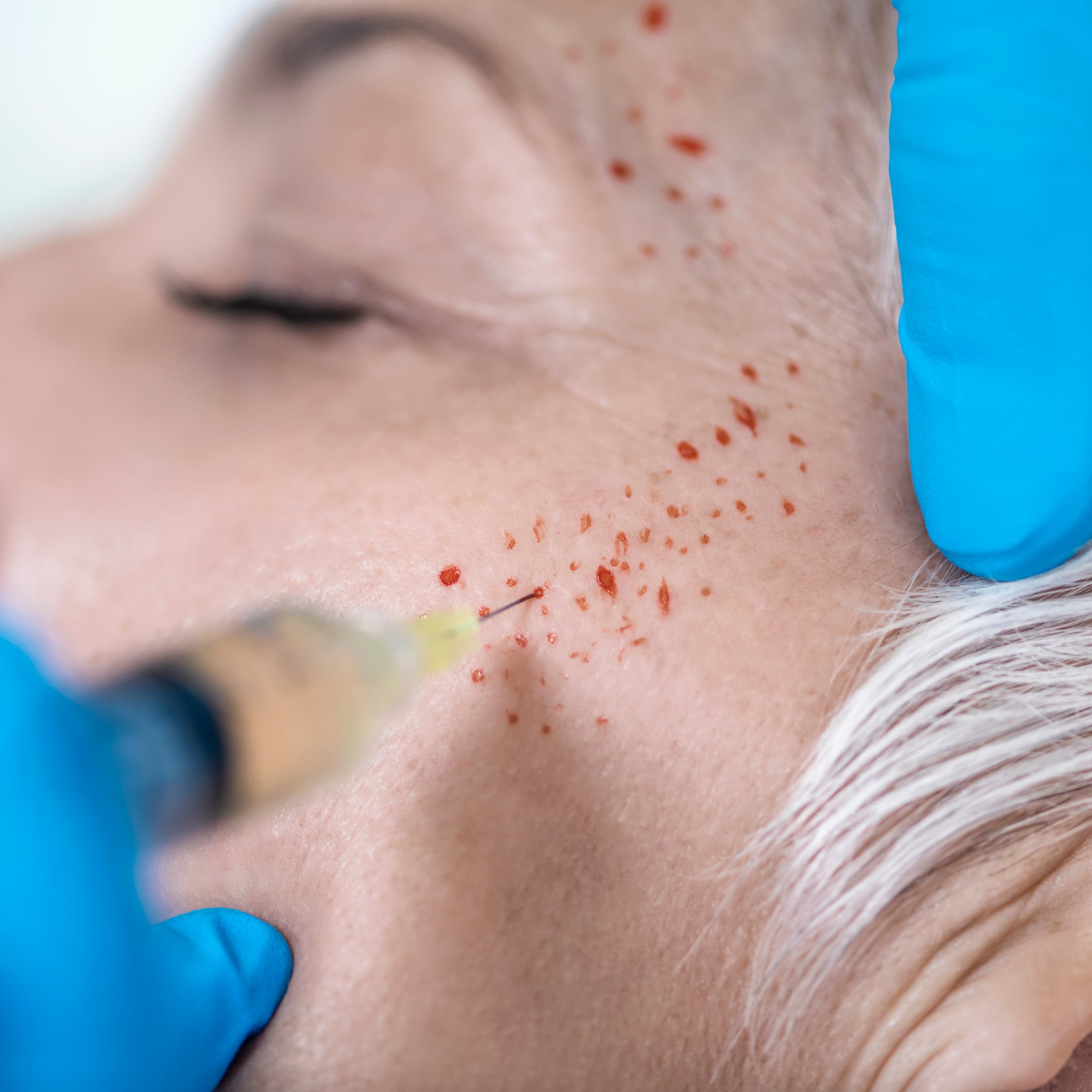 Phlebotomy & Vampire PRP